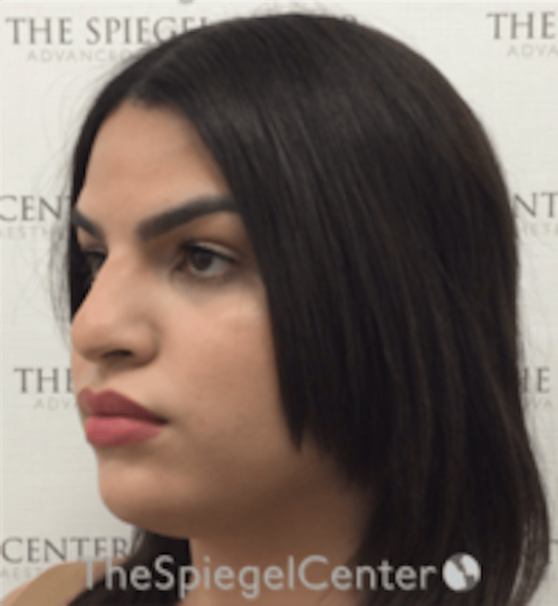 FFS Before & After Gallery - Patient 502303 - Image 3