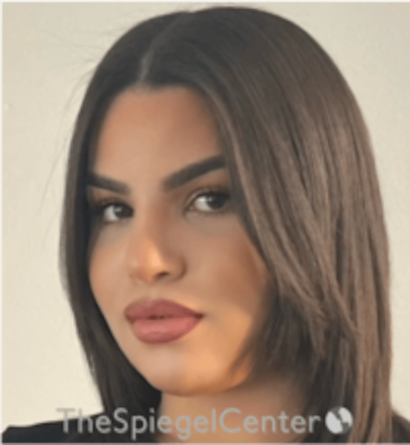 FFS Before & After Gallery - Patient 502303 - Image 4