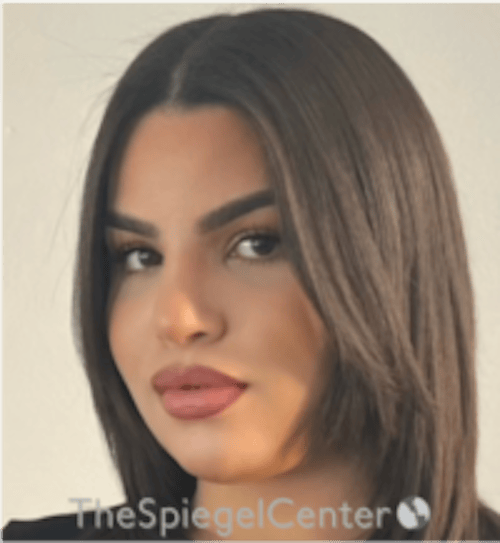 FFS Before & After Gallery - Patient 502303 - Image 4