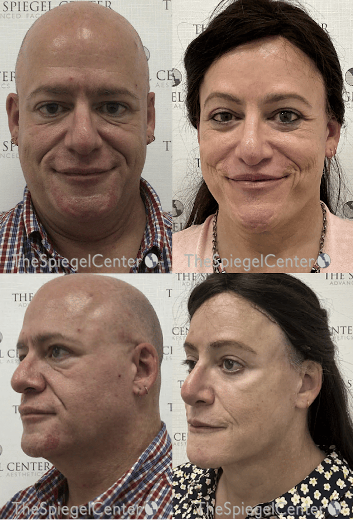 FFS Before & After Gallery - Patient 363279 - Image 1