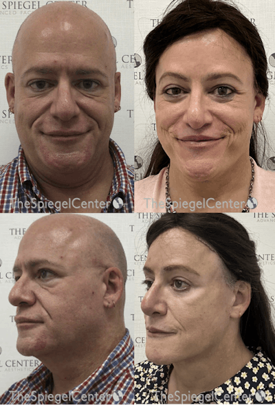 FFS Before & After Gallery - Patient 363279 - Image 1