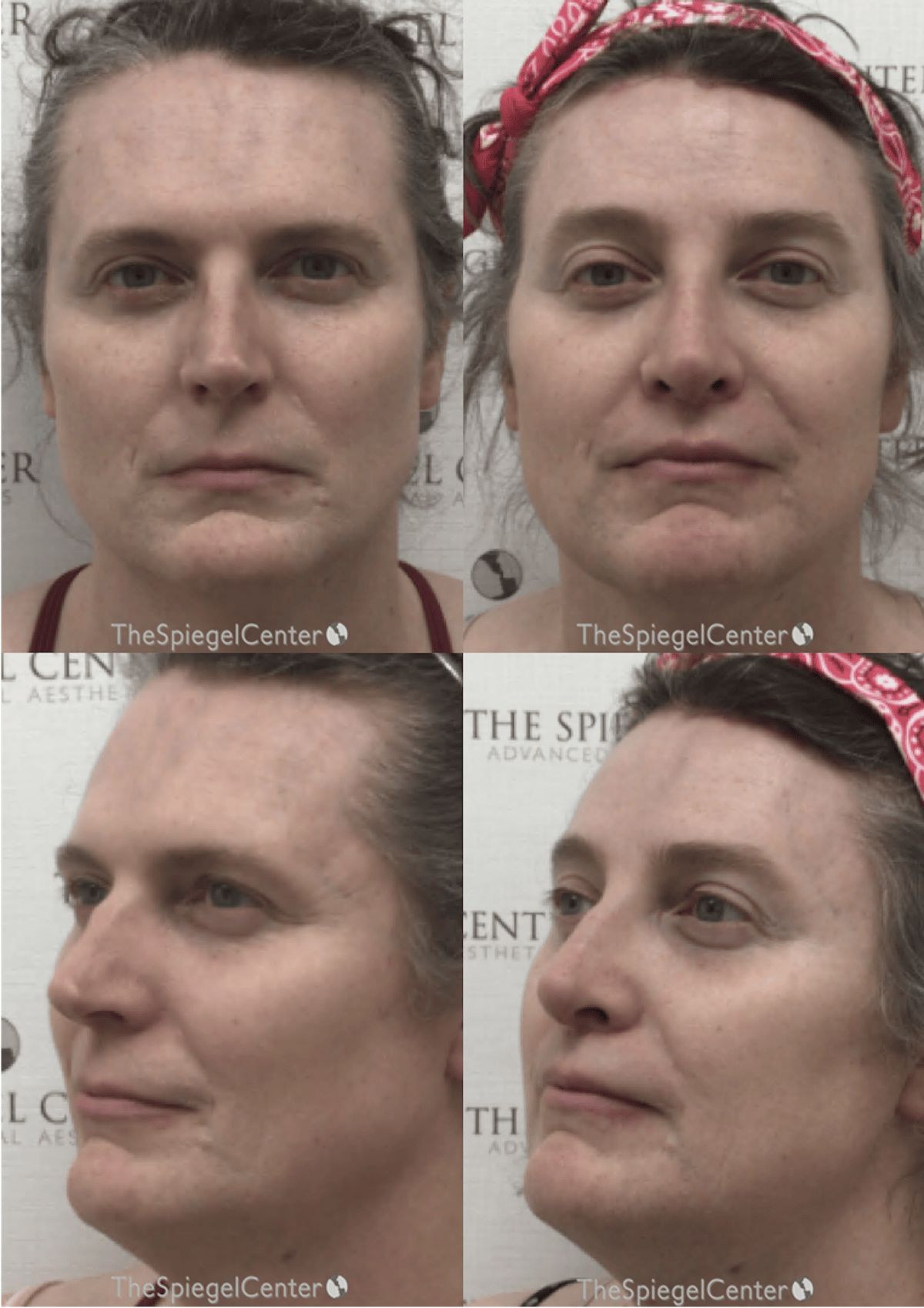 FFS Before & After Gallery - Patient 319716 - Image 1