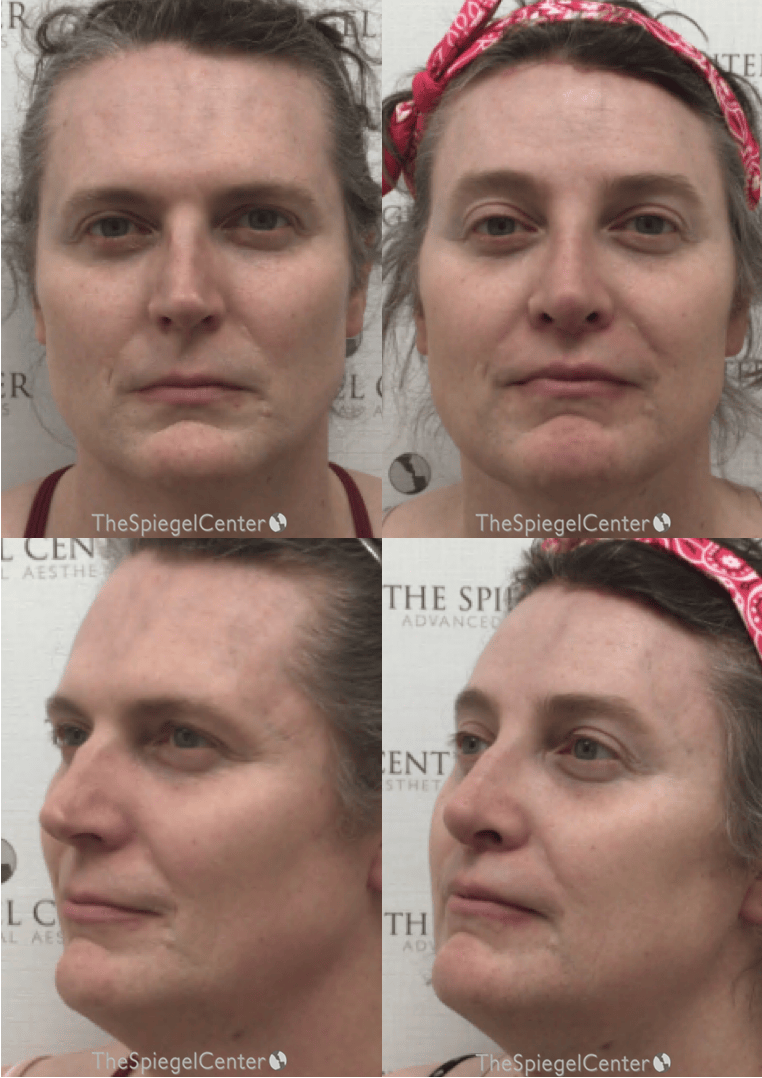 FFS Before & After Gallery - Patient 319716 - Image 1