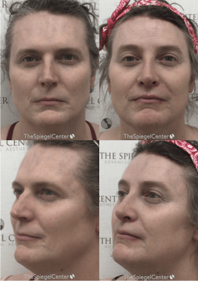 FFS Before & After Gallery - Patient 319716 - Image 1