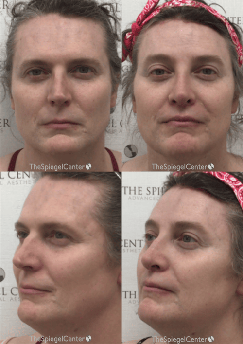 FFS Before & After Gallery - Patient 319716 - Image 1