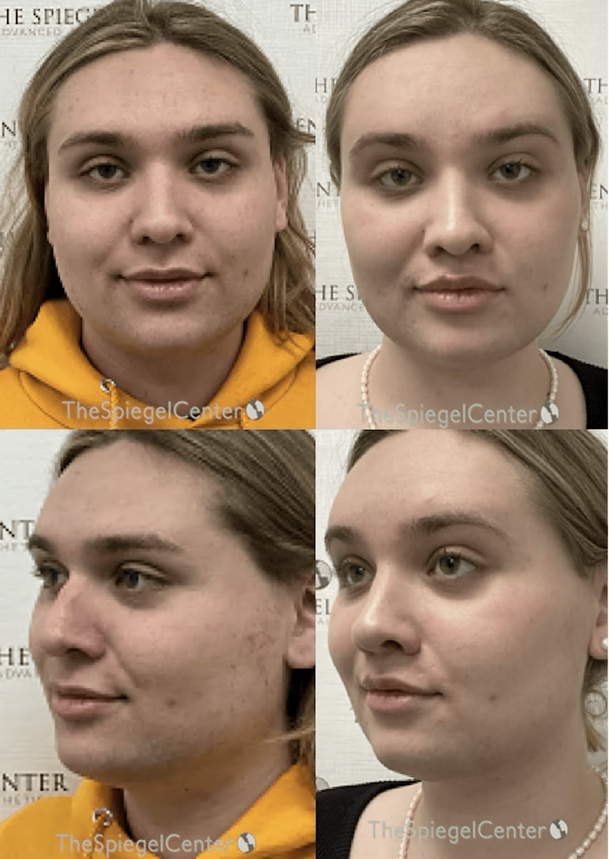 FFS Before & After Gallery - Patient 329483 - Image 1