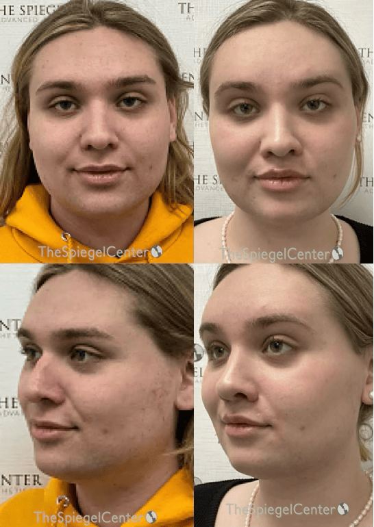 FFS Before & After Gallery - Patient 329483 - Image 1