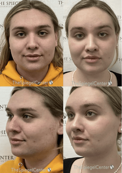 FFS Before & After Gallery - Patient 329483 - Image 1