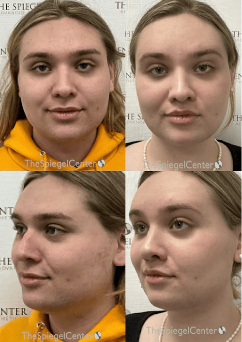 FFS Before & After Gallery - Patient 329483 - Image 1