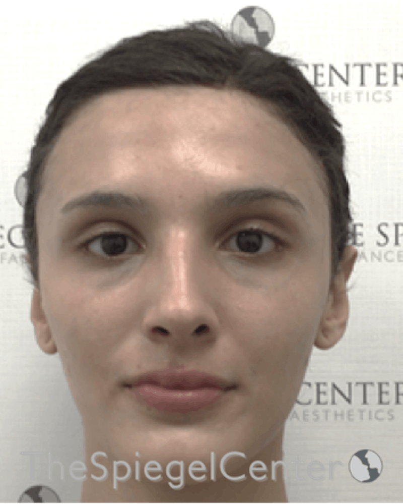 FFS Before & After Gallery - Patient 211805 - Image 1