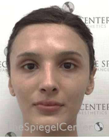 FFS Before & After Gallery - Patient 211805 - Image 1