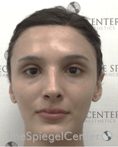 FFS Before & After Gallery - Patient 211805 - Image 1