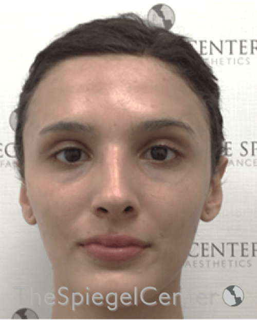 FFS Before & After Gallery - Patient 211805 - Image 1