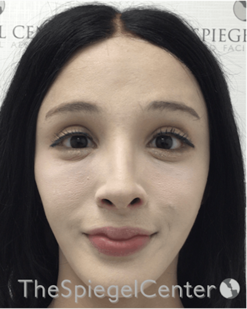 FFS Before & After Gallery - Patient 211805 - Image 2