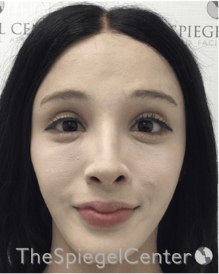 FFS Before & After Gallery - Patient 211805 - Image 2