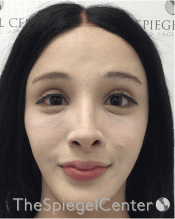 FFS Before & After Gallery - Patient 211805 - Image 2