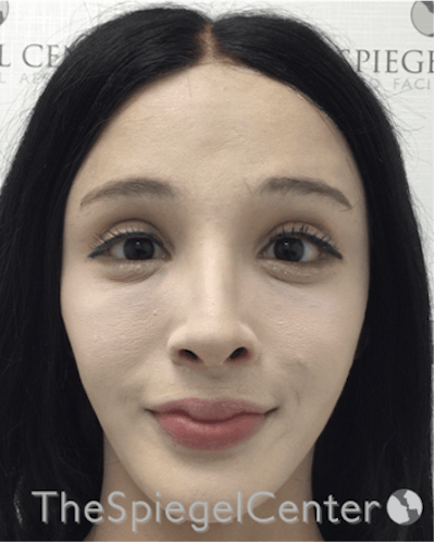 FFS Before & After Gallery - Patient 211805 - Image 2