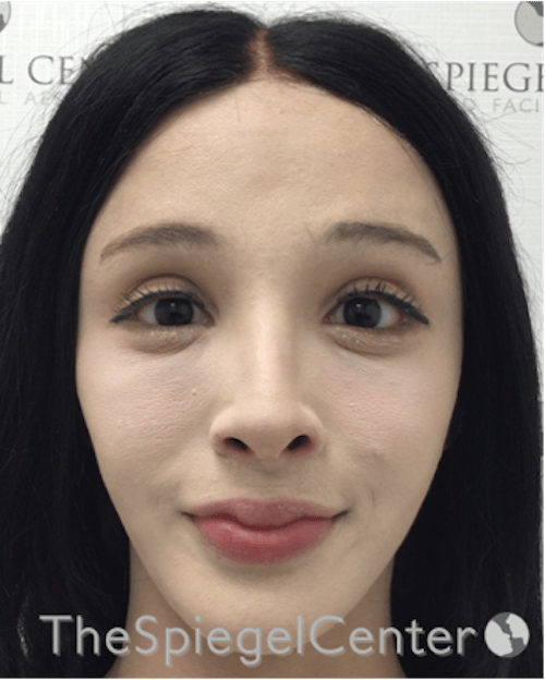 FFS Before & After Gallery - Patient 211805 - Image 2