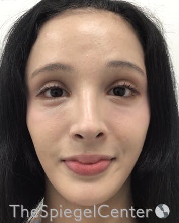 FFS Before & After Gallery - Patient 211805 - Image 3