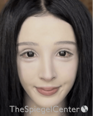 FFS Before & After Gallery - Patient 211805 - Image 4