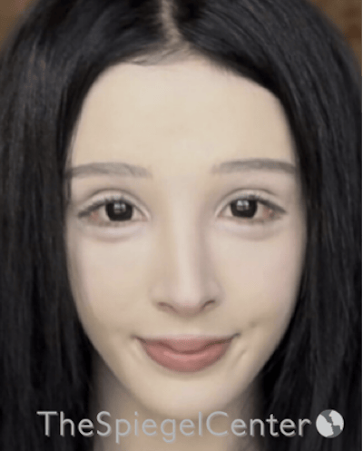 FFS Before & After Gallery - Patient 211805 - Image 4