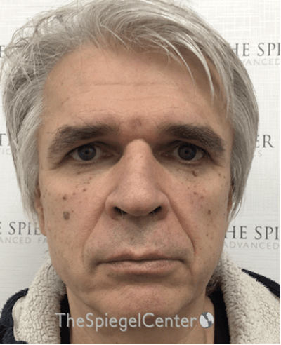 FFS Before & After Gallery - Patient 408347 - Image 1