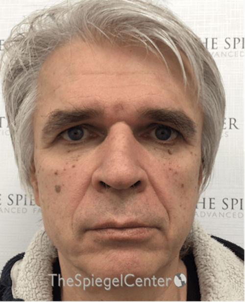 FFS Before & After Gallery - Patient 408347 - Image 1