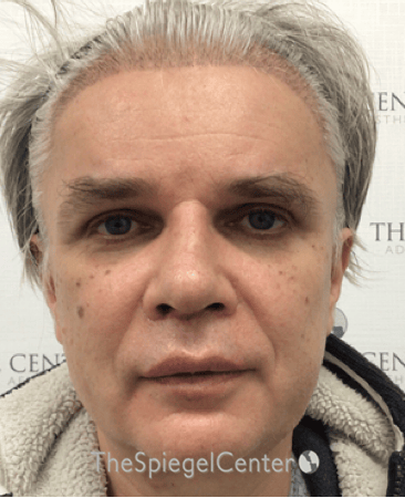 FFS Before & After Gallery - Patient 408347 - Image 2