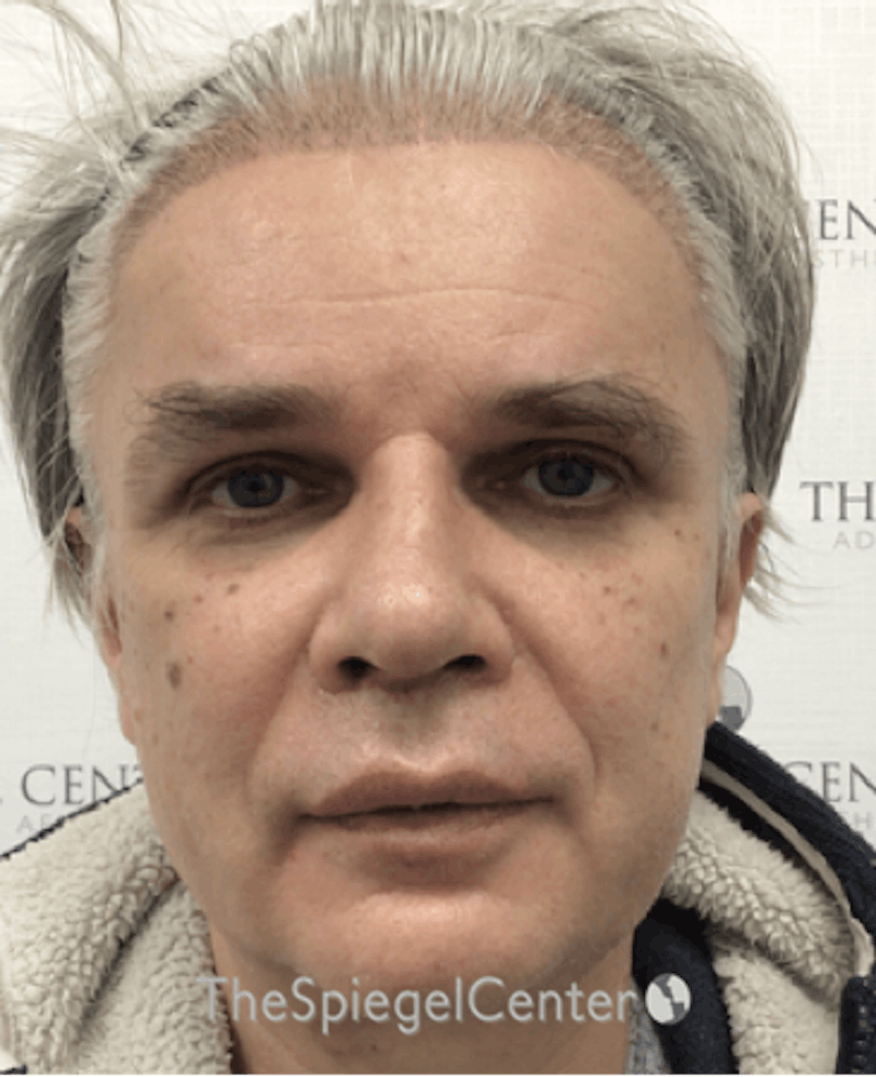 FFS Before & After Gallery - Patient 408347 - Image 2