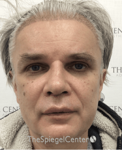 FFS Before & After Gallery - Patient 408347 - Image 2