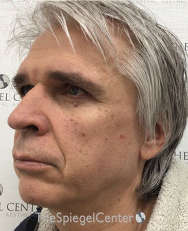 FFS Before & After Gallery - Patient 408347 - Image 3