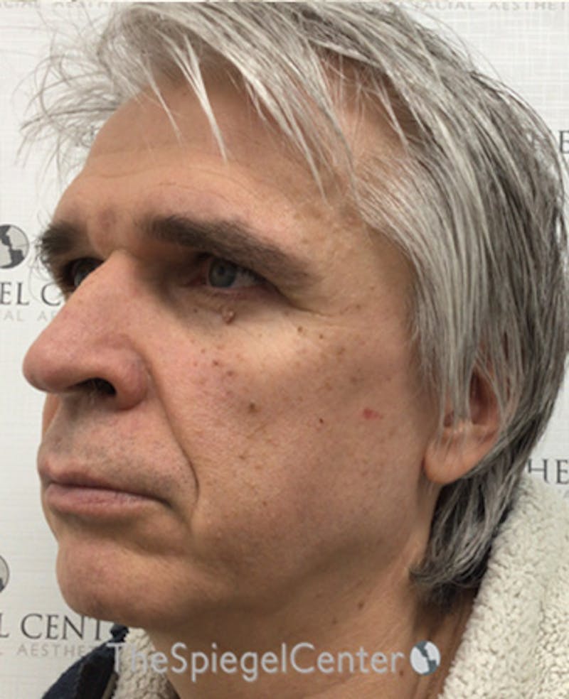 FFS Before & After Gallery - Patient 408347 - Image 3