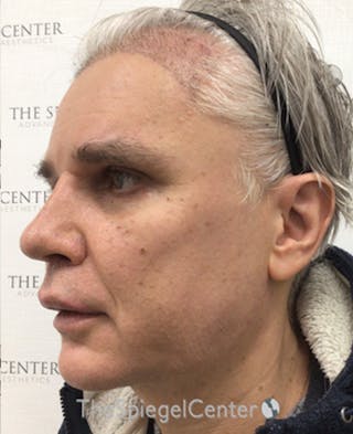 FFS Before & After Gallery - Patient 408347 - Image 4