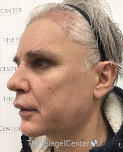 FFS Before & After Gallery - Patient 408347 - Image 4