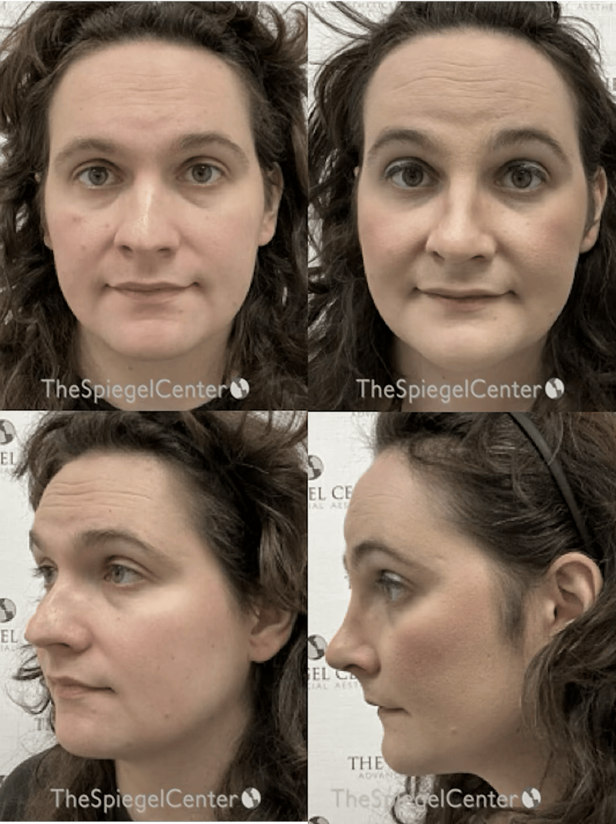 FFS Before & After Gallery - Patient 425853 - Image 1