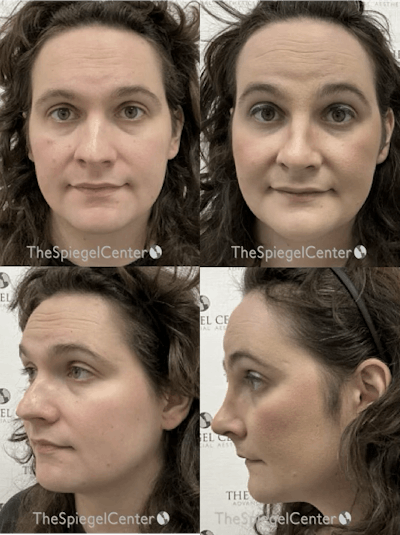 FFS Before & After Gallery - Patient 425853 - Image 1