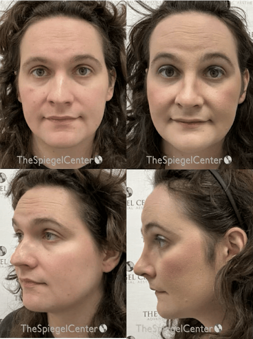 FFS Before & After Gallery - Patient 425853 - Image 1
