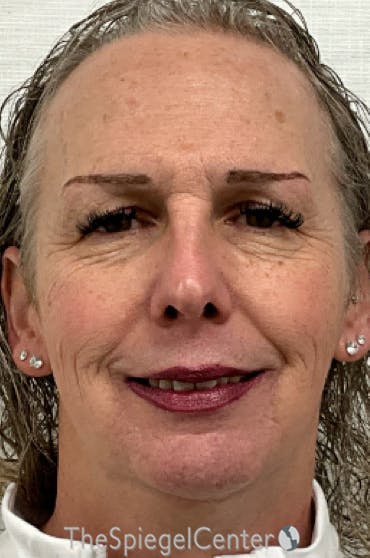FFS Before & After Gallery - Patient 343700 - Image 1