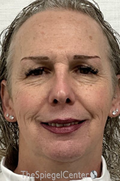 FFS Before & After Gallery - Patient 343700 - Image 1