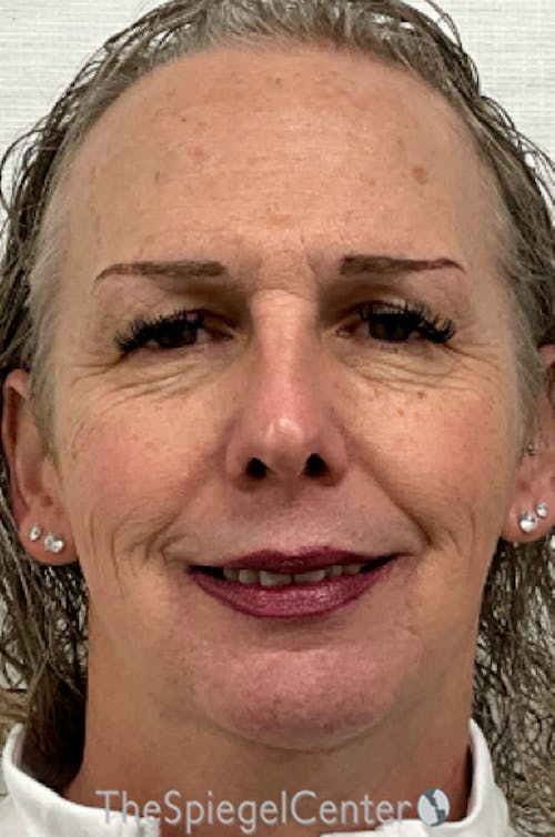 FFS Before & After Gallery - Patient 343700 - Image 1
