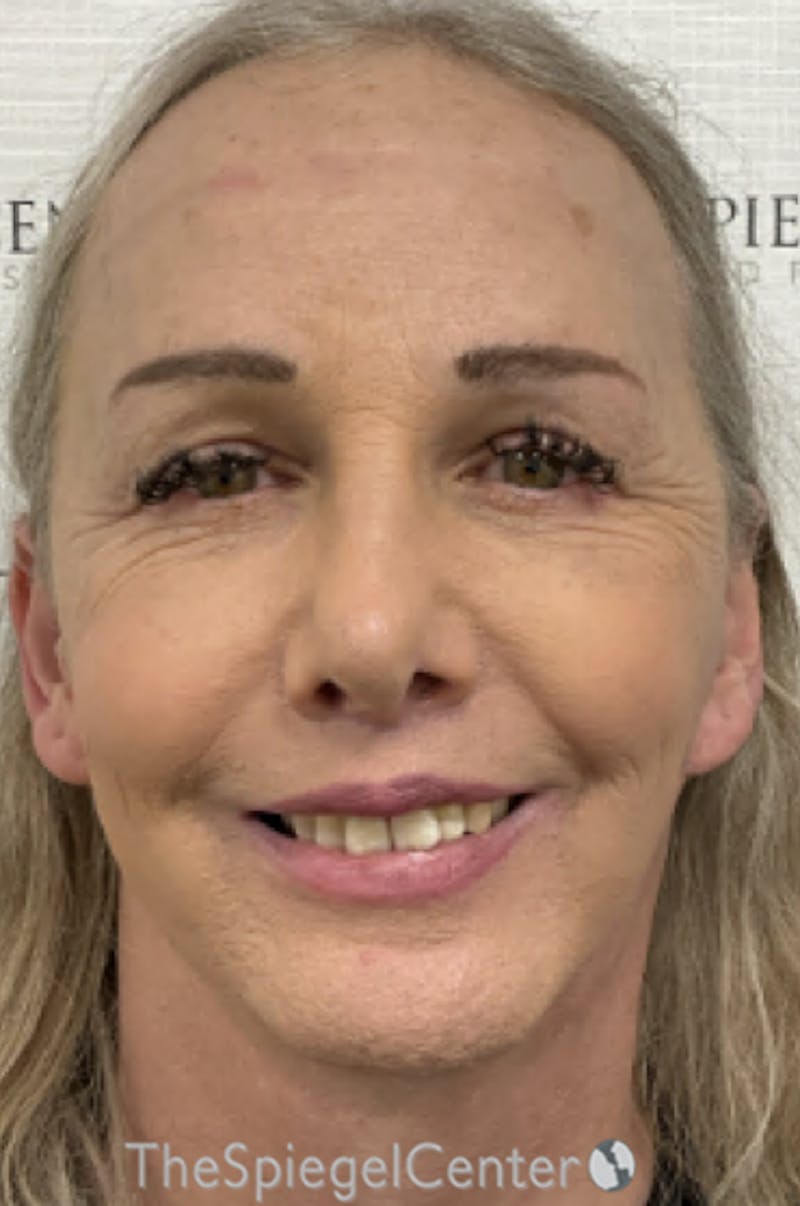 FFS Before & After Gallery - Patient 343700 - Image 2