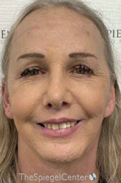 FFS Before & After Gallery - Patient 343700 - Image 2