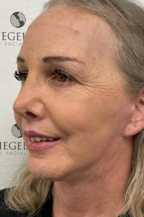 FFS Before & After Gallery - Patient 343700 - Image 4