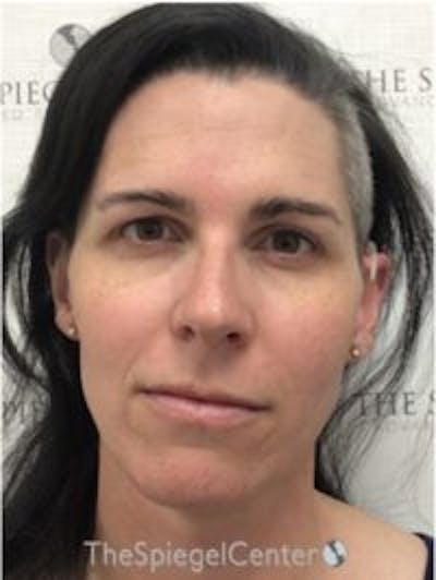 FFS Before & After Gallery - Patient 533321 - Image 1