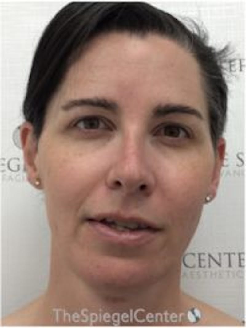 FFS Before & After Gallery - Patient 533321 - Image 2