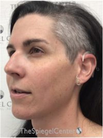 FFS Before & After Gallery - Patient 533321 - Image 3