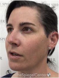 FFS Before & After Gallery - Patient 533321 - Image 4