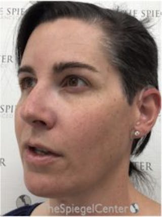 FFS Before & After Gallery - Patient 533321 - Image 4