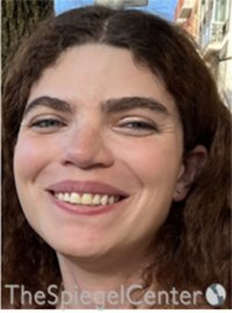 FFS Before & After Gallery - Patient 269093 - Image 2