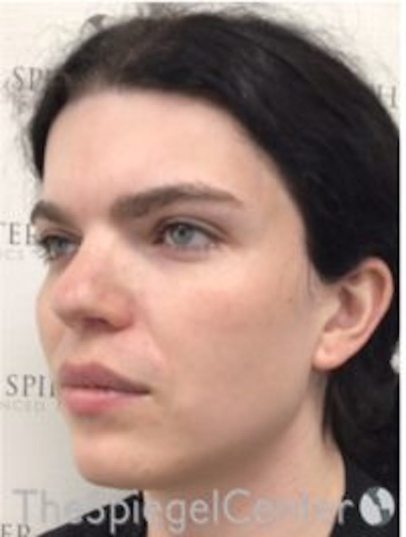 FFS Before & After Gallery - Patient 269093 - Image 3